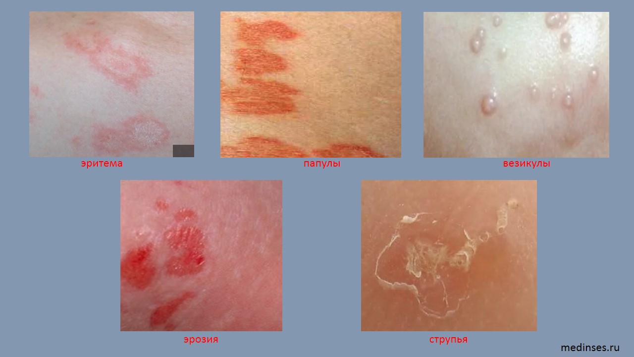 Кожные элементы при аллергических кожных заболеваниях