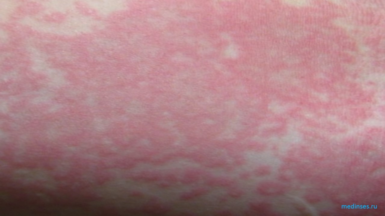Аллергические кожные заболевания, крапивница